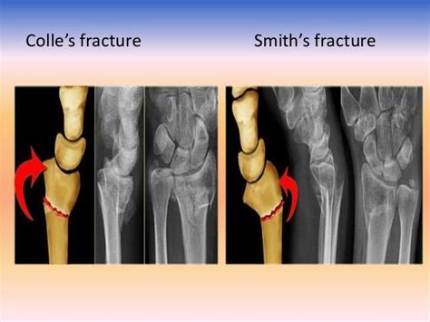 Colles Vs Smith Fracture - cloudshareinfo