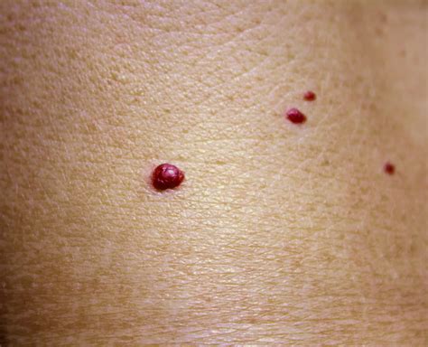 Cherry Angioma Removal: Apple Cider Vinegar And Other Home Remedies