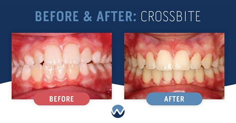 What's a Crossbite? 3 Case Studies Show How We Can Help • Woodhill ...