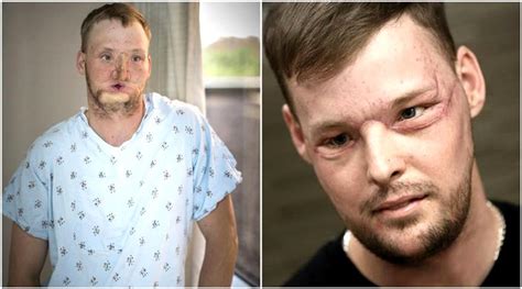 50-hour face transplant recovers US man’s wounded face after 10 years | The Indian Express