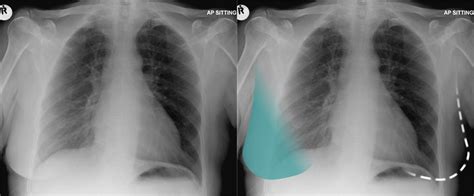 Chest X-ray Abnormalities - Soft tissue abnormalities