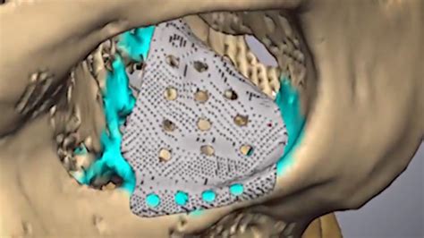 Surgeons complete eye socket repair using metal AM and augmented reality