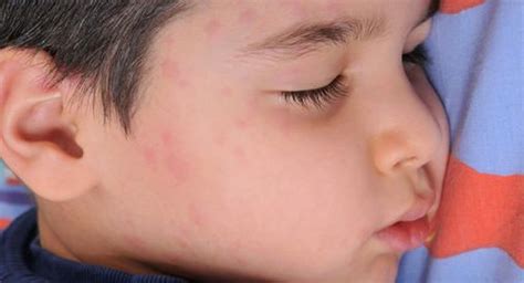 Hives (Urticaria): Triggers, Causes, Types, Symptoms, Diagnosis & Treatment