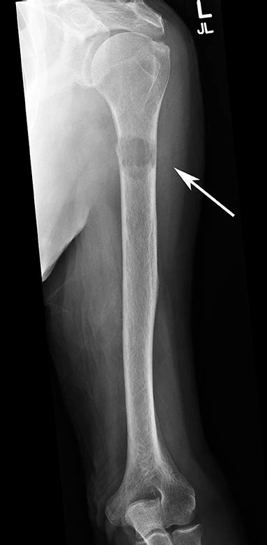 Frontiers | Multimodal Treatment of Bone Metastasis—A Surgical ...