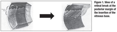 Scleral buckling surgery: As vital as ever