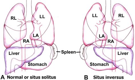 Dextrocardia types, dextrocardia situs inversus, causes, symptoms, ECG & complications