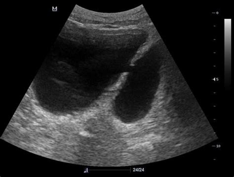 Bladder diverticulum | Radiology Case | Radiopaedia.org | Radiology, Bladder, Basic anatomy and ...