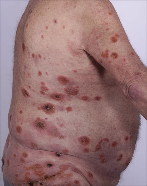 Fatal Cytotoxic Cutaneous Lymphoma Presenting as Ulcerative Psoriasis ...