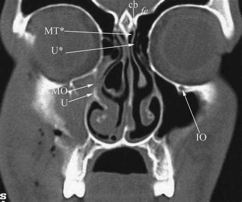 Radiology Anatomy Images : CT PNS anatomy