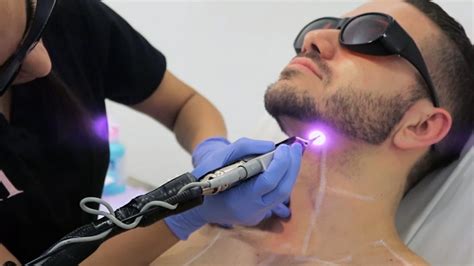 Laser Hair Removal for Men NYC - Laser Services LaserWorks