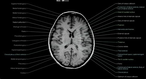 Brain MRI - NeurologyNeeds.com | Brain, Mri, Arc of the covenant