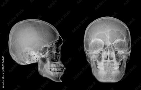Very good quality X-ray image of normal human skull front (AP) view and side (Lateral) view ...
