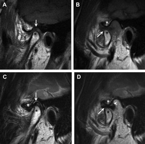 Tmj Mri