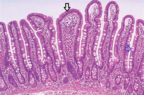 Histopatología: PATOLOGIA DEL INTESTINO DELGADO Y COLON