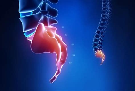 Treatment Coccyx pain | Spine and Orthopedic Specialists: NEO Surgical Group