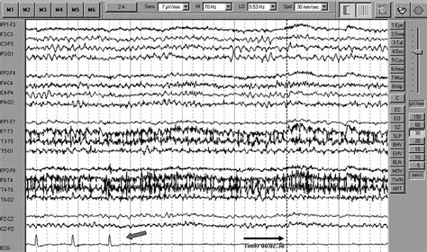 Stokes Adams Syndrome Pdf - Captions Pages