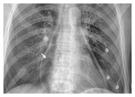 Pneumopericardium — NEJM