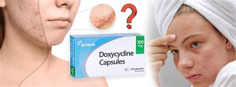 doxycycline for acne