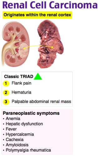 Renal cell carcinoma Flashcards | Quizlet