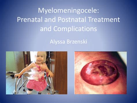 Myelomeningocele: Prenatal and Postnatal Treatment and