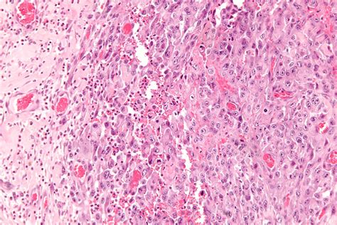 File:Epithelioid sarcoma - high mag.jpg - Wikimedia Commons