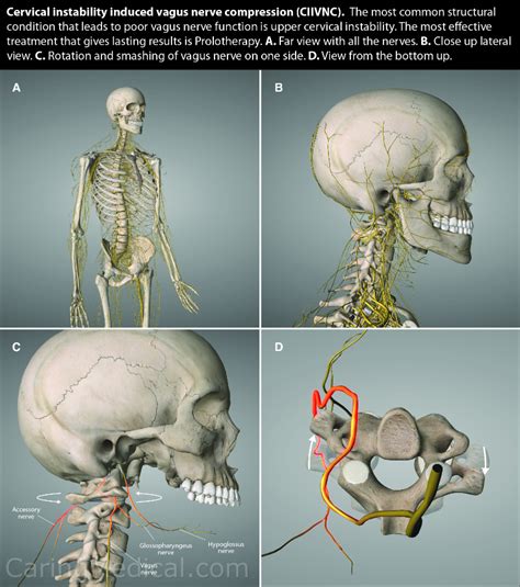 Vagus nerve compression in the neck: Symptoms and treatments