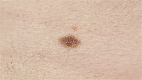 Melanoma symptoms: How to spot signs, and when to see a doctor