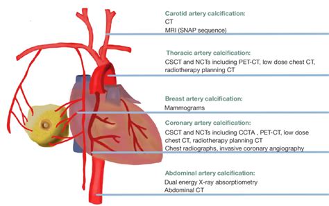 The anatomical locations of the 5 types of vascular calcification, as ...