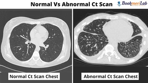 CT Scan Chest: Purpose, Results, COVID-19 & Cost [2022]