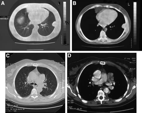 CT scans of primary solitary fibrous tumor of the pleura (1A-B) and the ...