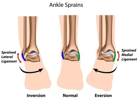 Anterior Talofibular Ligament Sprain