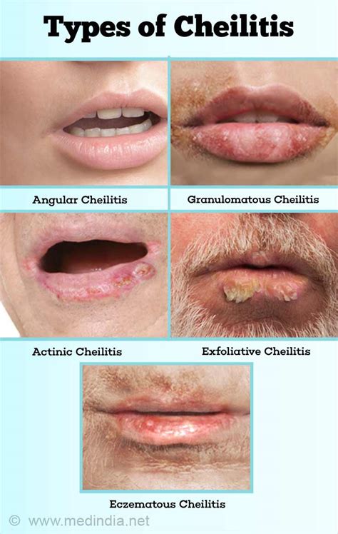 Cheilitis - Causes, Symptoms, Diagnosis & Treatment