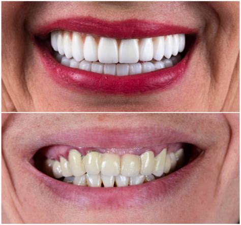 Front Teeth Crowns Vs. Veneers | Emerald Coast Dentistry