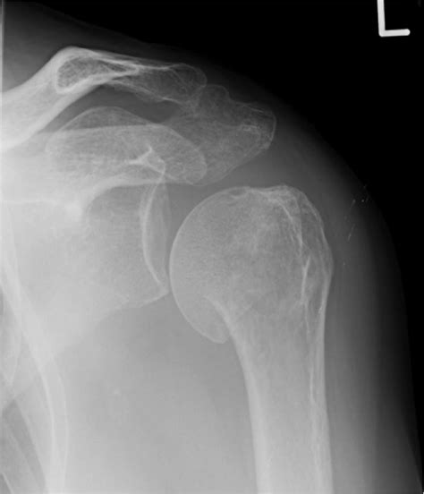 Mechanisms Of Humeral Head Fracture