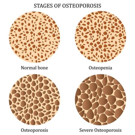 Understanding Low Bone Density: Causes & Symptoms,