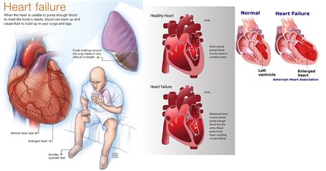 Pathophysiology - Heart Failure