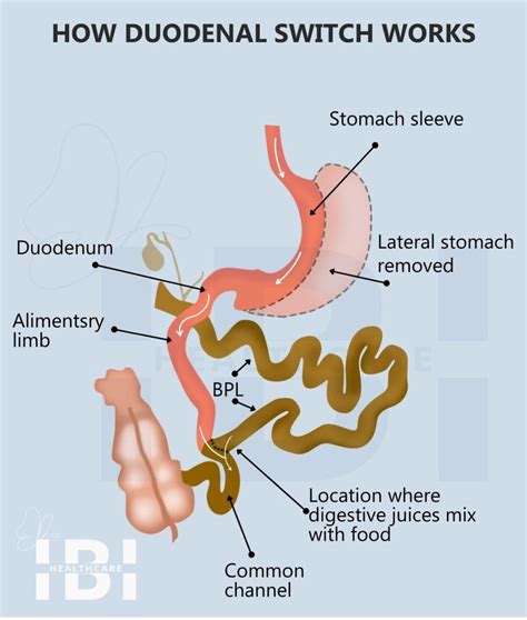 Duodenal Switch Surgery (BPD-DS) - Weight Loss For BMI 40+