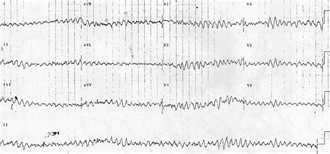 Ventricular Fibrillation (VF) • LITFL • ECG Library Diagnosis