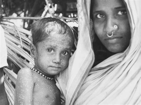 How Rahima came to hold a special place in smallpox history — and help ...