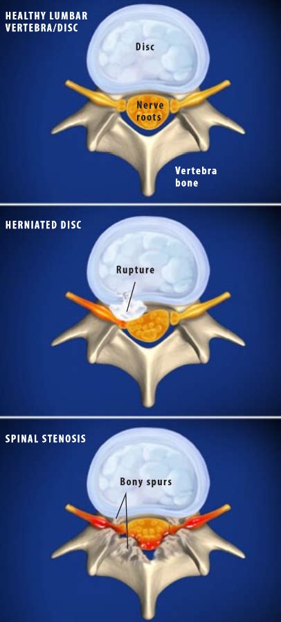 Lumbar Radiculopathy (Sciatica) | Central Coast Orthopedic Medical Group