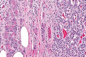 Neuroendocrine tumour of the pancreas - Libre Pathology