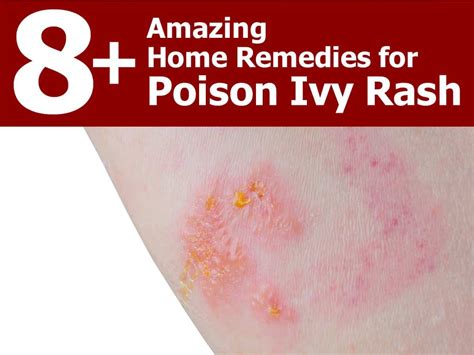 home-remedies-for-poison-ivy-rash | Poison ivy rash, Poison ivy ...