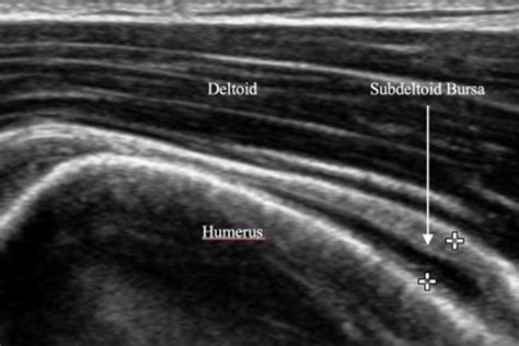 Subdeltoid Bursitis Ultrasound