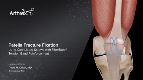 Arthrex - Patella Fracture Fixation Using Cannulated Screws with FiberTape® Tension Band ...