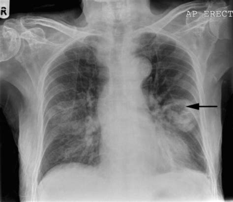 Pneumonia Manifestation Seen And Diagnosed Via X-Rays: Different Radiographs To Show Lung Tissue ...