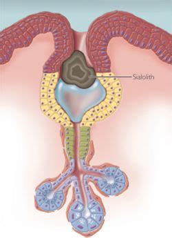 Sialolithiasis - Causes, Symptoms, Diagnosis and Treatment