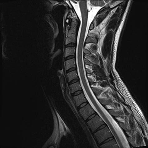 Normal Cervical Spine Mri Image Radiopaedia Org | Sexiz Pix