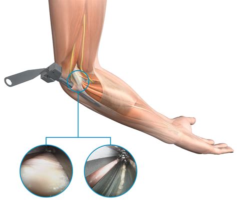 Endoscopic Cubital Tunnel Release (ECuTR) - Trice Medical