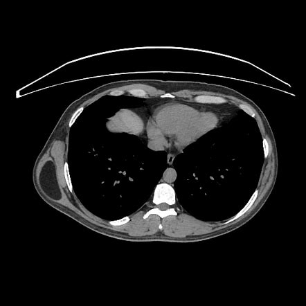 Intramuscular lipoma | Radiology Reference Article | Radiopaedia.org