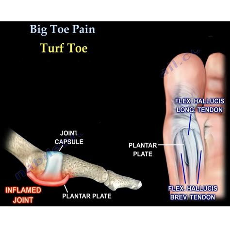 Great toe Pain — OrthopaedicPrinciples.com